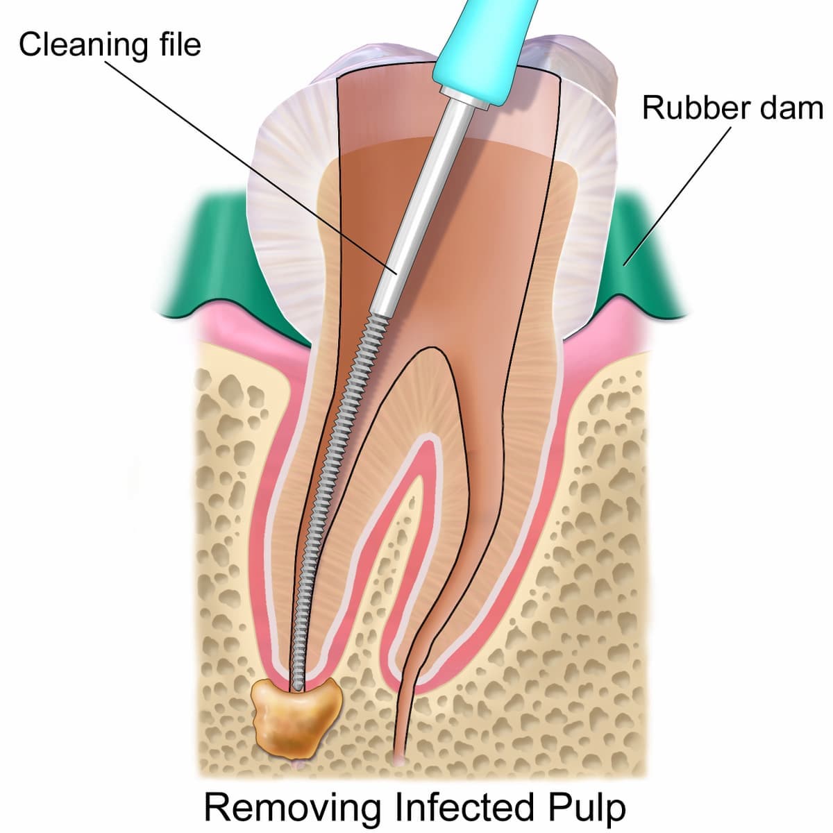 The Root Canal Treatment Process